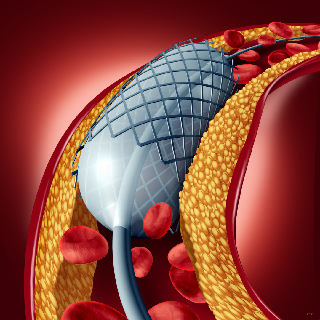 Balloon Angioplasty