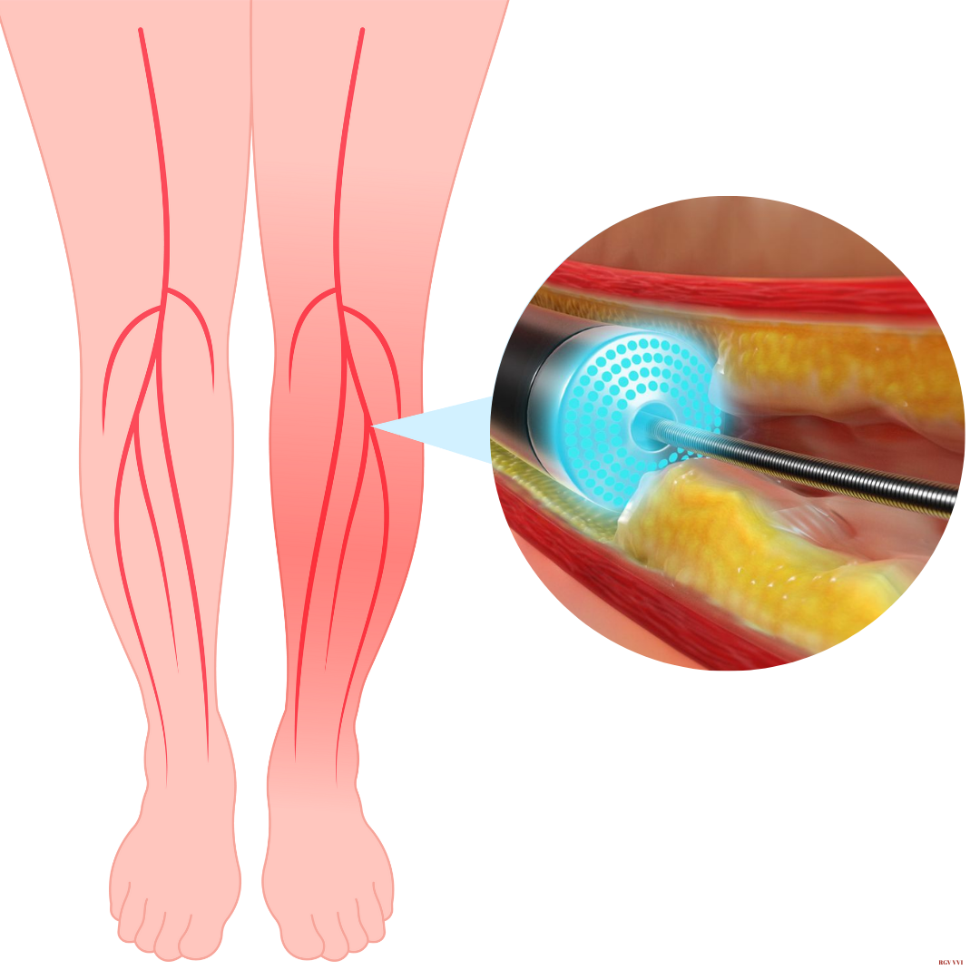 Lower Extremities Atherectomy