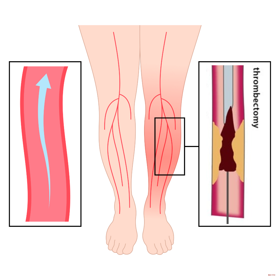 _Lower Extremities Thrombectomy