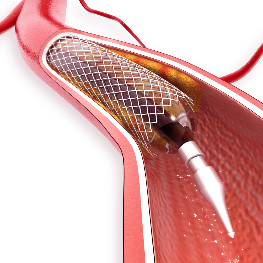 venoplasty (balloonstent)